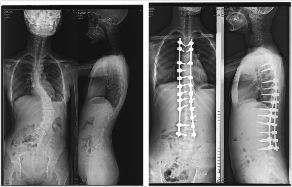 脊柱侧弯矫形手术成功实施13岁花季少女挺直脊梁