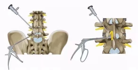 脊柱退变与畸形外科为81岁高龄腰椎管狭窄症患者施行ube微创手术
