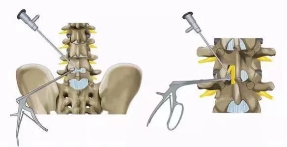 椎管狭窄手术图解图片