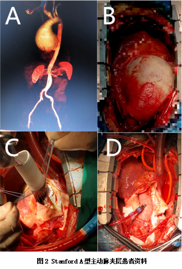 主动脉弓缩窄手术图片